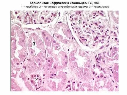 Поражение канальцев почки