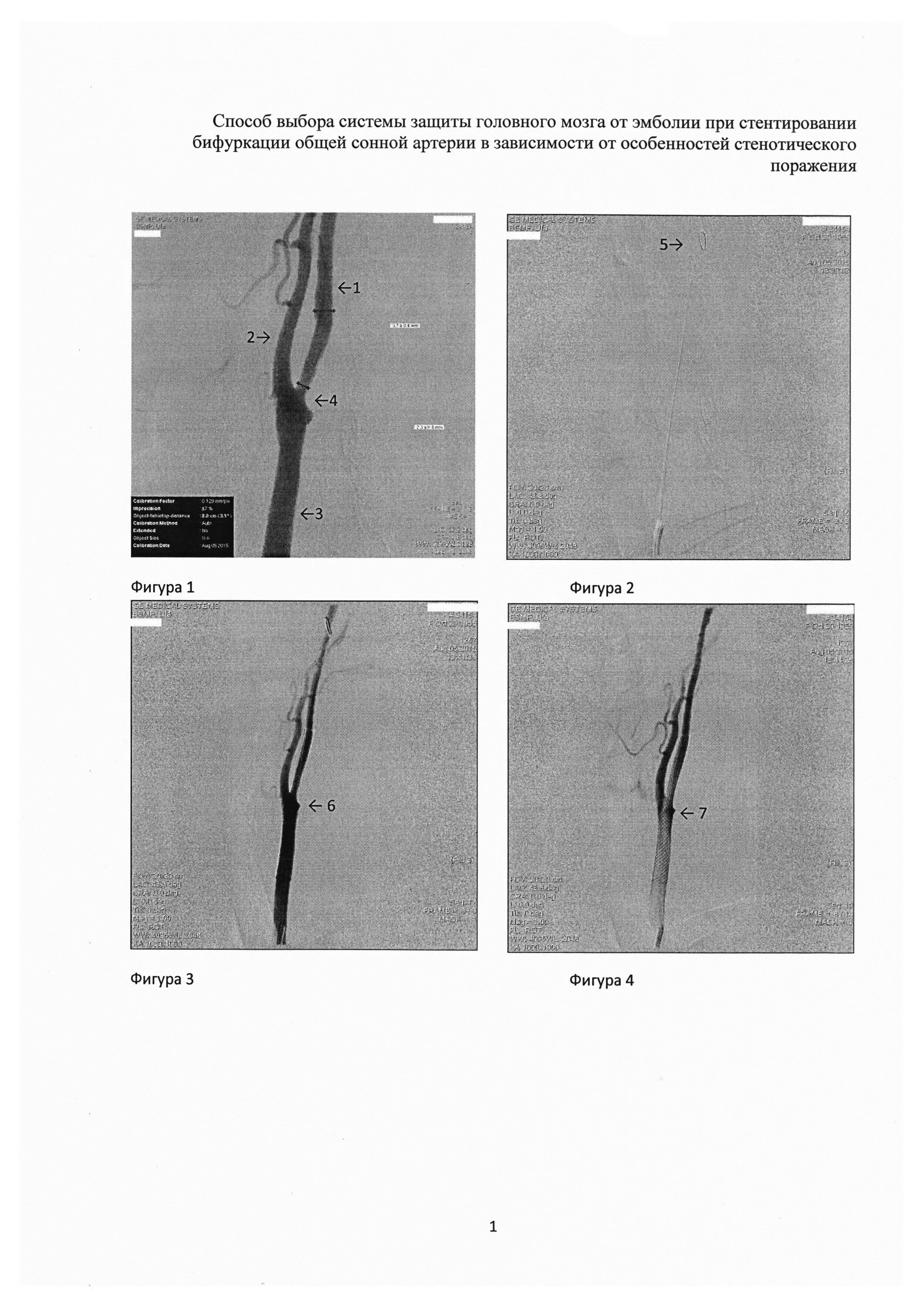 Бифуркация сонной артерии. Хеморецепторы дуги аорты. Уровень бифуркации общей сонной артерии. Бифуркация общей сонной артерии происходит на уровне:. Зона бифуркации сонной артерии.