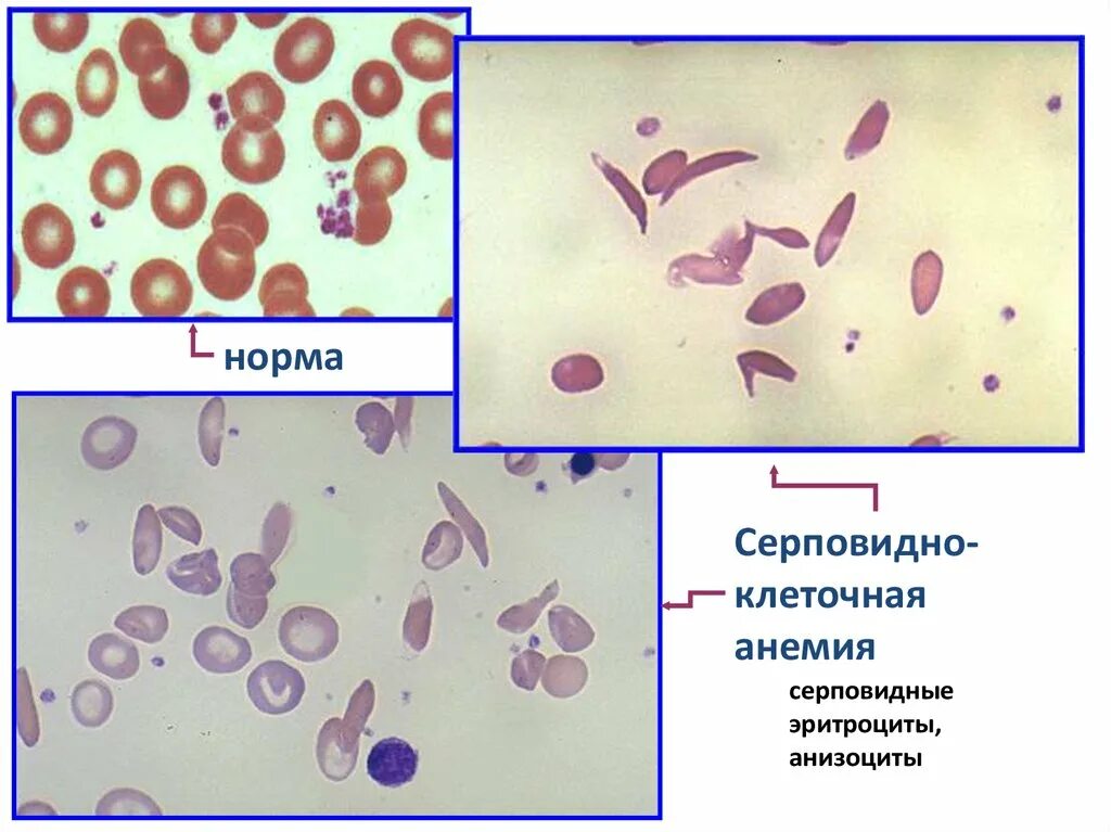 Эритроциты при серповидно клеточной анемии. Серповидноклеточная анемия мазок крови. Серповидноклеточная анемия картина крови. Серповидно клеточная анемия эритроциты. Серповидноклеточная анемия показатели крови.