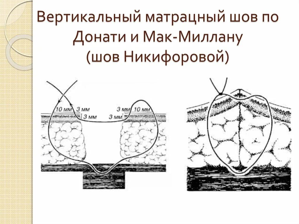 Шов по донати техника. Хирургический шов макмиллана донати. Техника шов шов мак-миллана - донати. Шов по донати техника. Вертикальный матрацный шов по донати.