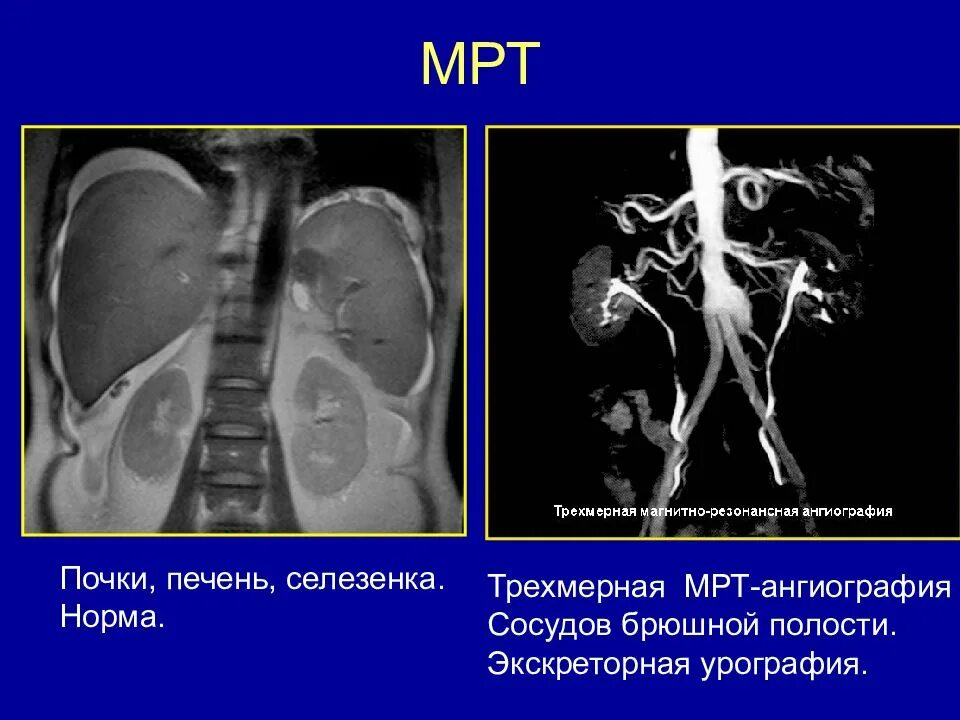 Мрт печени почек