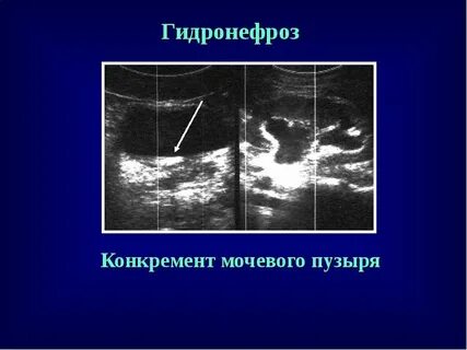 Конкременты мочевых путей