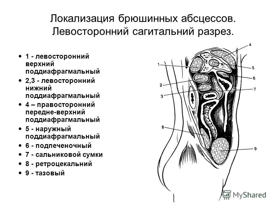 При передневерхней локализации абсцесс формируется. Абсцесс сальниковой сумки. абсцесс сальниковой сумки кт. абсцесс сальниковой сумки диагностика.