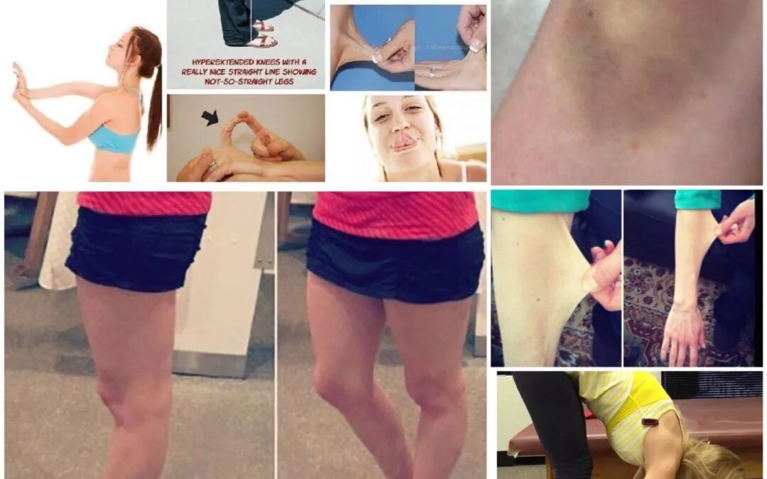 Классификация синдрома элерса-данло. Синдром элиса. Классификация синдрома элерса-данло. Синдром элиса. Синдром элерса данлоса классификация.