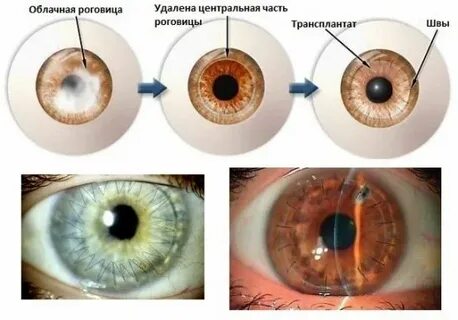 Роговица у взрослого