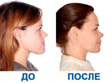 Гениопластика