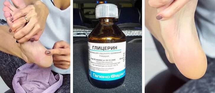 Парим аптечный глицерин. Жидкость от натоптышей на ногах. глицерин от натоптышей. средства для облегчения мозолей. салициловая кислота от мозолей.