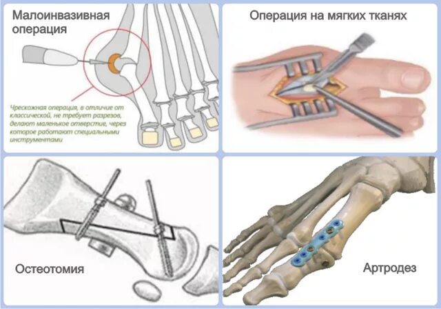 Коррекция деформаций стопы