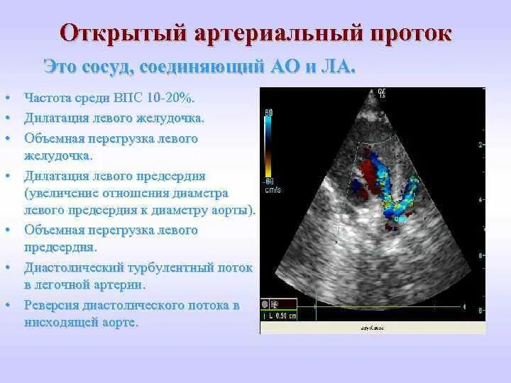 Впс открытый. Врожденный порок сердца открытый артериальный проток. открытый артериальный проток &quot;{jru pfrk.xtybt. открытый аортальный проток у новорожденного.