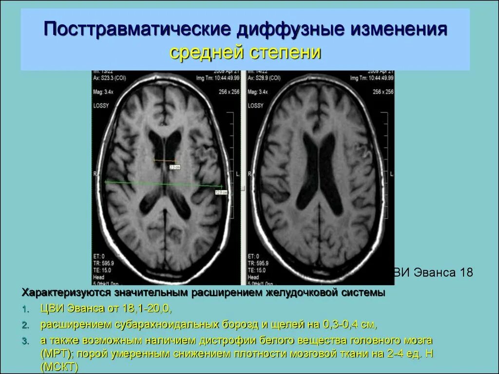 Диффузные изменения головного мозга. Цви эванса. посттравматические изменения головного мозга кт. посттравматические изменения головного мозга на мрт.
