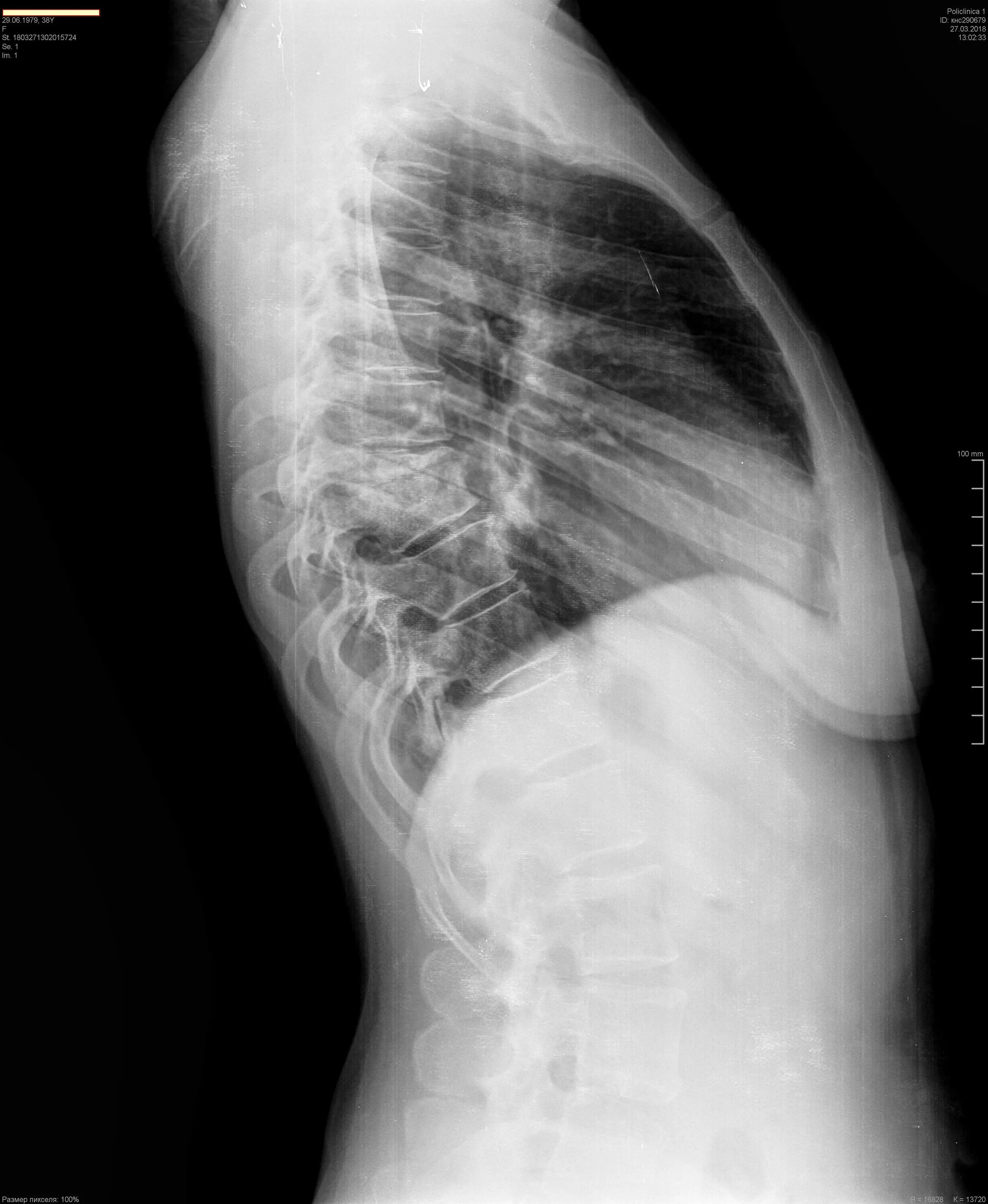 Рентгенограмма грудного отдела позвоночника в боковой проекции. Рентгенография грудины в боковой проекции. Рентген грудного отдела позвоночника боковая проекция. Рентген грудной клетки боковая проекция. Рентгенография позвоночника в 2 х проекциях