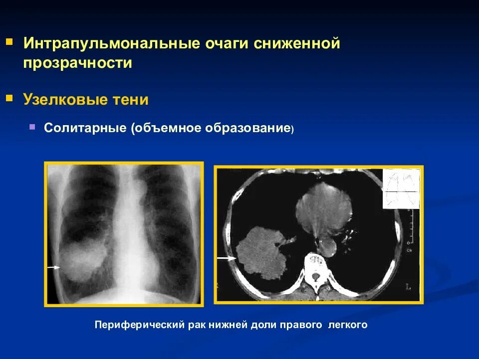 Рак нижней доли. Периферическое образование правого легкого. Периферическое образование левого легкого. Периферия образование правого легкого. Объемное образование правого лёгкого.