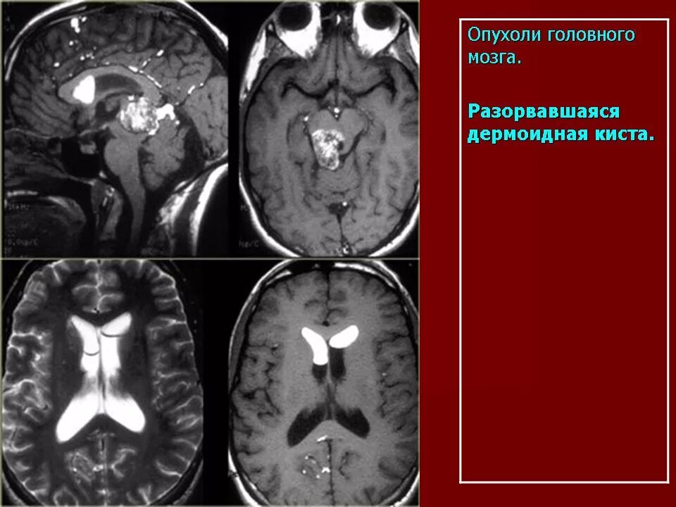 Постишемические кисты мозга. Ретроцеребральная киста. Ретроцеребеллярная арахноидальная киста кт. Дермоид головного мозга кт. Герминома пинеальной области.