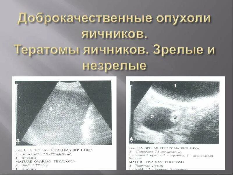 Климакс на узи. Зрелая тератома яичника УЗИ. УЗИ признаки тератомы яичника. Незрелая тератома яичников.