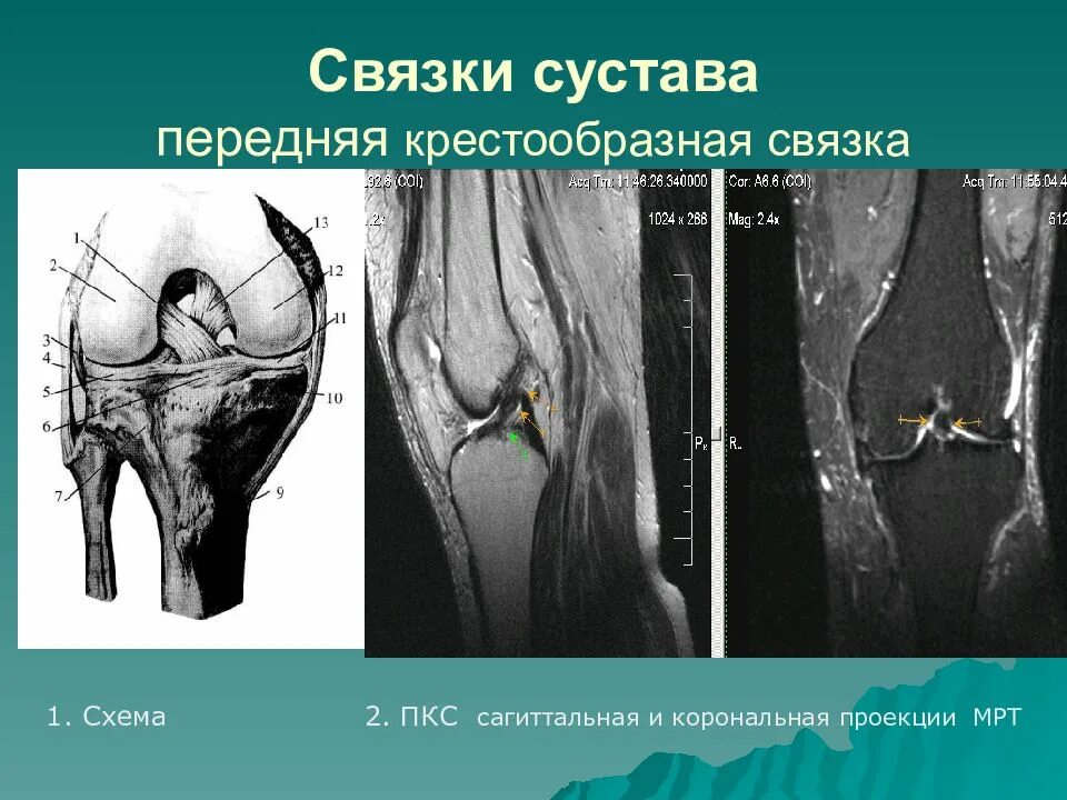 ПКС (передняя крестообразная связка). Задняя крестообразная связка коленного сустава анатомия. Разрыв крестообразной связки коленного сустава на мрт. Разрыв передней крестообразной связки мрт схема. Полный разрыв передней крестообразной