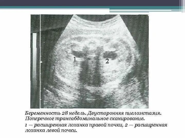 Расширение почки плода при беременности. Расширение лоханки почки на УЗИ. Расширение лоханки почки при беременности. УЗИ почек расширение лоханки левой почки. Расширение лоханки у ребенка