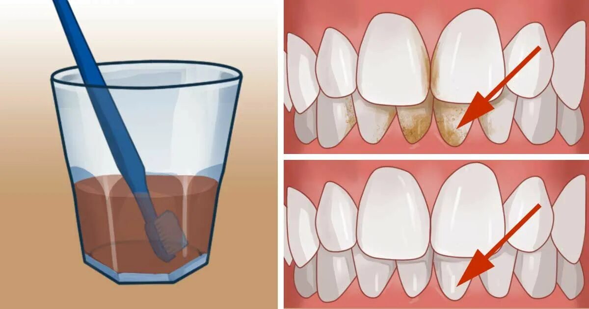 Коричневый зубной камень. Как чистить десна