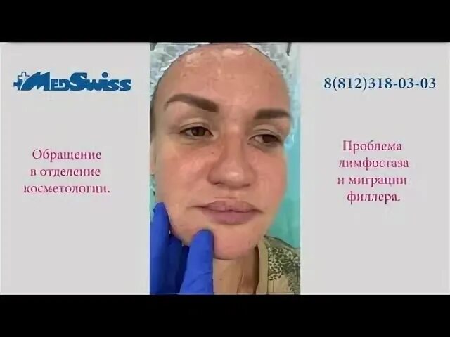 Почему мигрирует филлер. Из за чего может мигрировать филлер.
