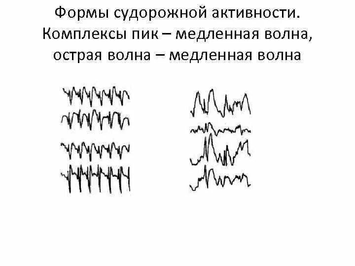 Комплекс острая волна медленная волна на ЭЭГ. Комплекс пик волна острая медленная. Спайки на ЭЭГ. Комплексы пик волна на ЭЭГ. Медленные волны на ээг