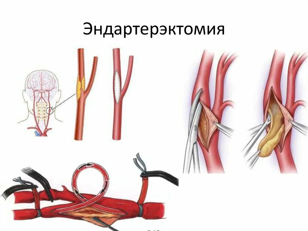 Шунтирование артерий нижних конечностей. Эндартерэктомия атеросклероз. Каротидная эндартерэктомия показания. Операция каротидная эндартерэктомия ход операции. Эверсионная каротидная эндартерэктомия ход операции.