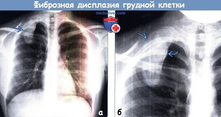 Фиброзная дисплазия ребра рентген. Полиостозная фиброзная дисплазия. Дисплазия ребра. Дисплазия ребра. Фиброзная дисплазия ребра кт.