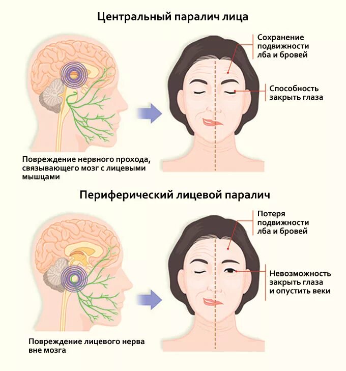 Инсульт парализация левой стороны. Неврит лицевого нерва инфекции. Неврит лицевого нерва излечим. Паралич лицевого нерва неврология. Неврит лицевого нерва лечение немедикаментозное.