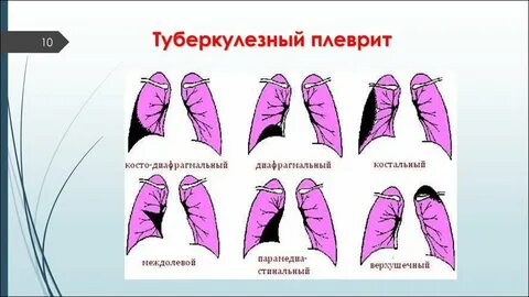 Туберкулез плеврит