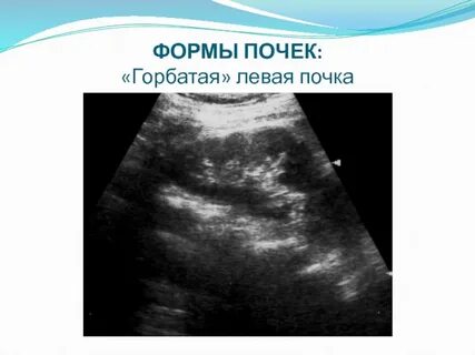 Узи почек набережные