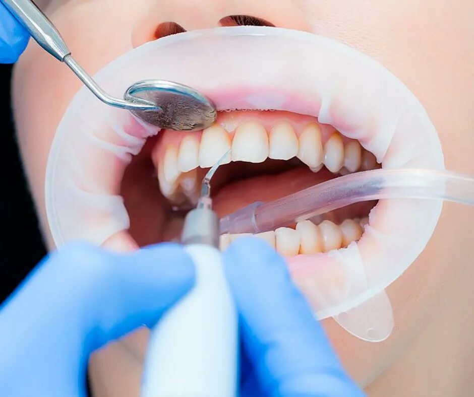 Чистка зубов казань. Профгигиена полости рта с коффердамом. Чистка зубов у стоматолога СПБ.