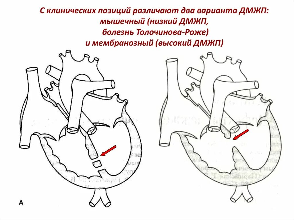 Код мкб дмжп у детей