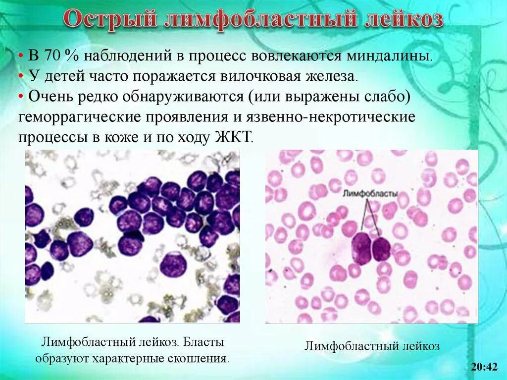 Острый лимфоцитарный лейкоз. Острый лимфобластный и миелобластный лейкоз. L2 лимфобластный лейкоз. Лимфобластный лейкоз в2 клеточный. Лимфобластный лейкоз у взрослых