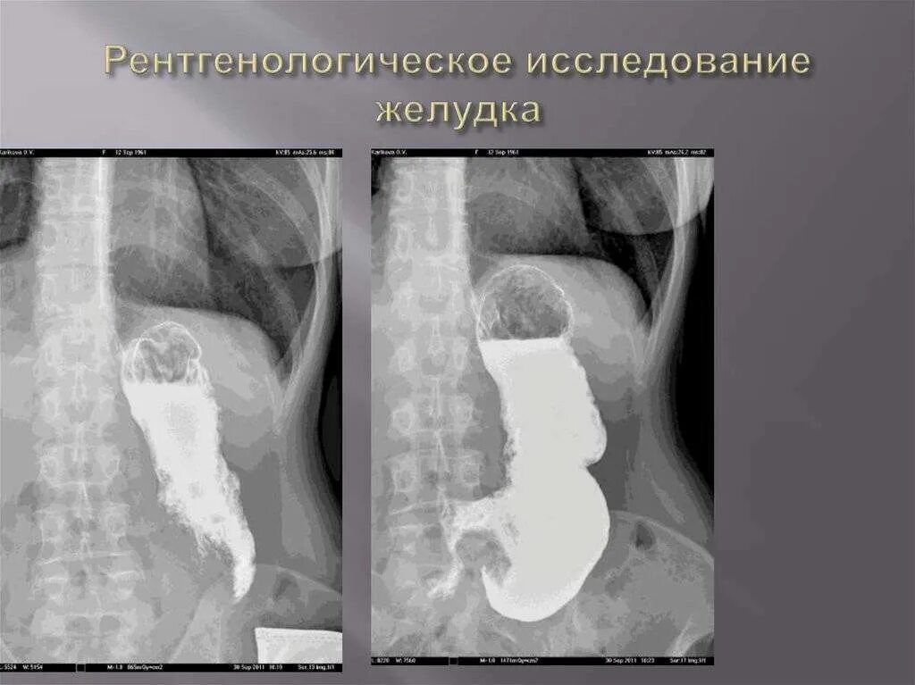 Рентген с барием что показывает