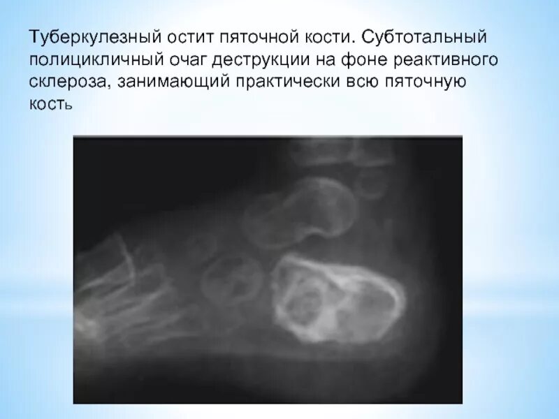 Туберкулезный склероз. Туберкулёз пяточной кости кт. туберкулезный остит рентген.