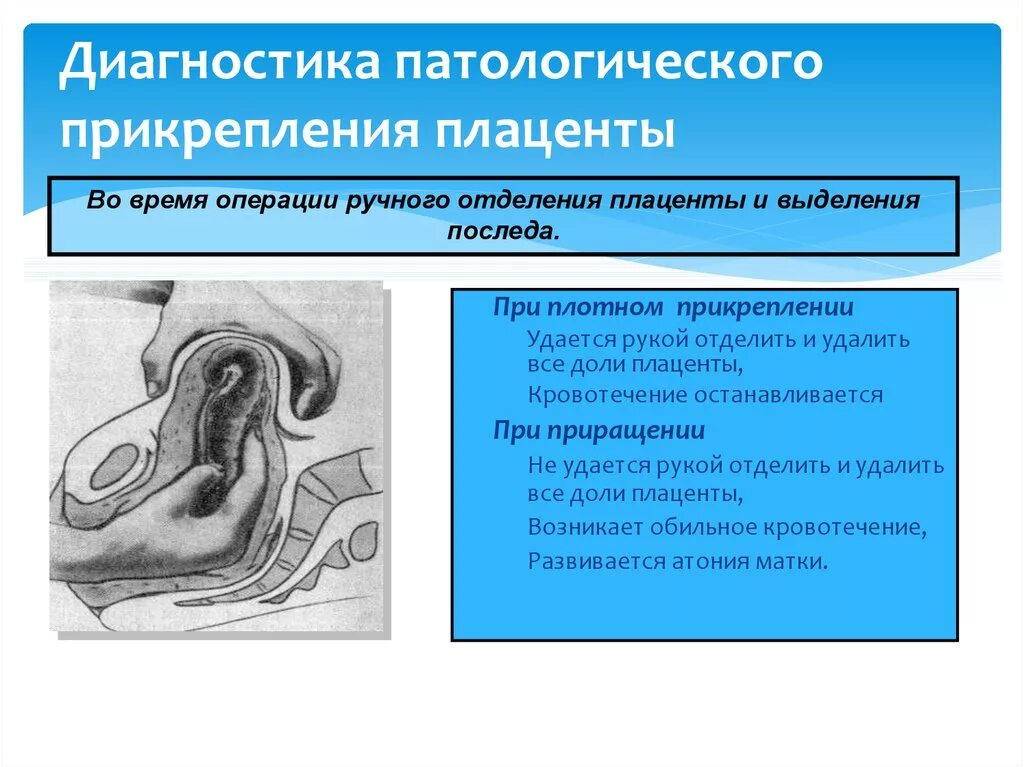 Способы ручного отделения плаценты. Плотное прикрепление последа. Патологическое прикрепление плаценты. Ручное отделение плаценты осложнения.