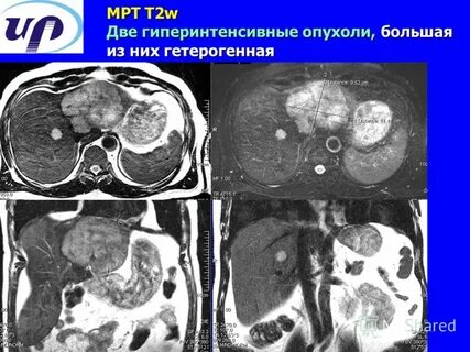 Что значит гиподенсивное образование в печени