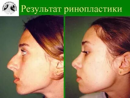 Больница ринопластики
