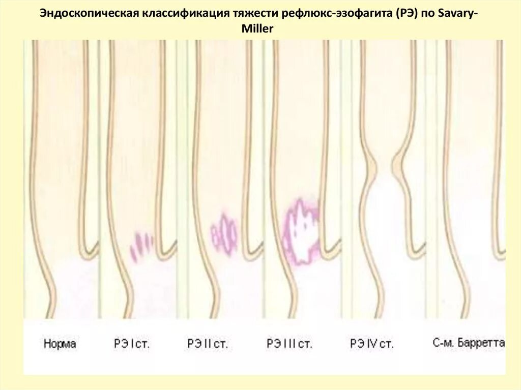 Классификация рефлюкс эзофагита Савари Миллер. Рефлюкс эзофагит эндоскопическая классификация. Лос Анджелесская классификация ГЭРБ. ГЭРБ по Савари Миллер. Классификации эндоскопия