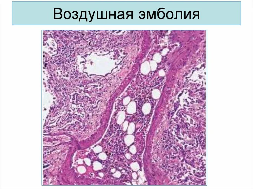 Воздушная эмболия при инъекции. Газовая эмболия гистология. воздушная эмболия сосудов. воздушная эмболия сосудов лёгких.
