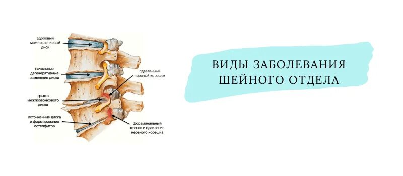 Протрузия дисков шейного отдела лечение. Шейный отдел позвоночника с4-с7. с4-с5 позвонки остеохондроз. двигательный сегмент шейного отдела 5-6 позвонка. сегмент с5 -с7 шейного отдела.
