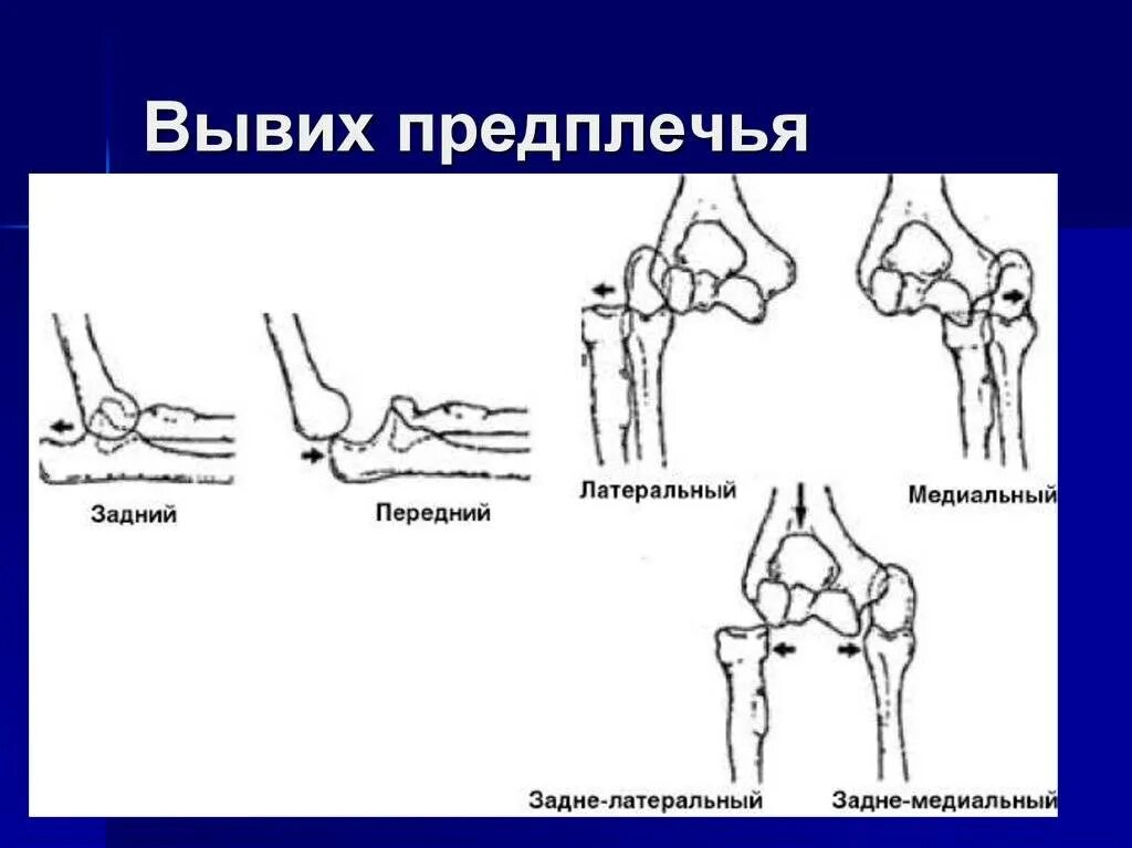 Подвывих локтевого сустава у ребенка. Вывихи локтевого сустава классификация. вывихи предплечья классификация. классификация вывихов костей предплечья в локтевом суставе,. вывихи в локтевом суставе у детей классификация.