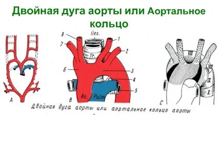 Дуга аорты