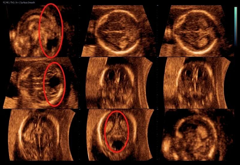 Гипоплазия червя. Гипоплазия червя мозжечка. Гипоплазия червя мозжечка на УЗИ. Гипоплазия червя мозжечка у плода на УЗИ. Гипоплазия червя мозжечка мрт.
