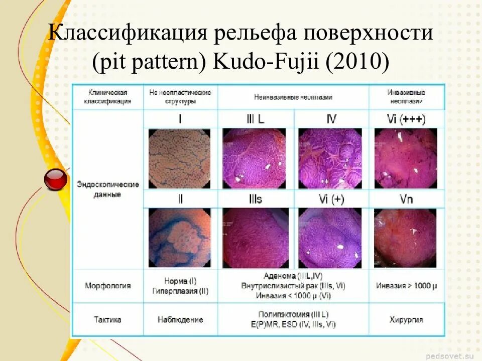 Классификация рельефа поверхности Pit pattern Kudo-Fujii 2010. Классификация ямочного рисунка по КУДО. Kudo классификация полипов. Классификация полипов желудка эндоскопическая. Классификации эндоскопия