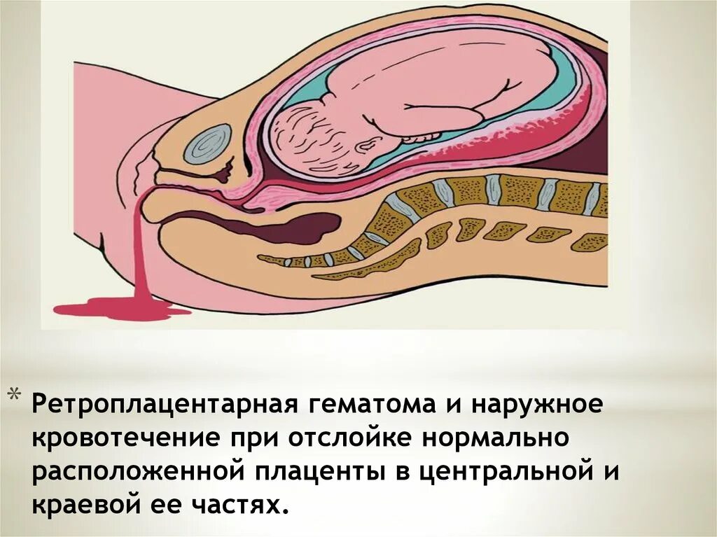 Почему кровь из матки. Отслойка плаценты патанатомия. Ретроплацентарная гематома. Ретроплацентарная гематома образуется. Отслойка плаценты подоболочечная.