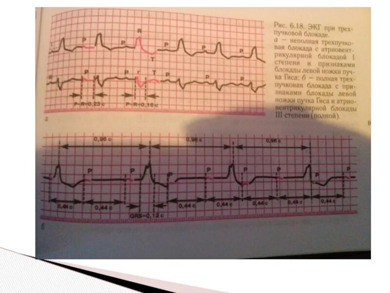 Что значит внутрипредсердная внутрипредсердная блокада. Внутрипредсердная блокада на ЭКГ. Внутрипредсердная блокада 2 степени на ЭКГ. Степени внутрипредсердной блокады. Внутрипредсердная блокада 1 степени на ЭКГ что это такое.