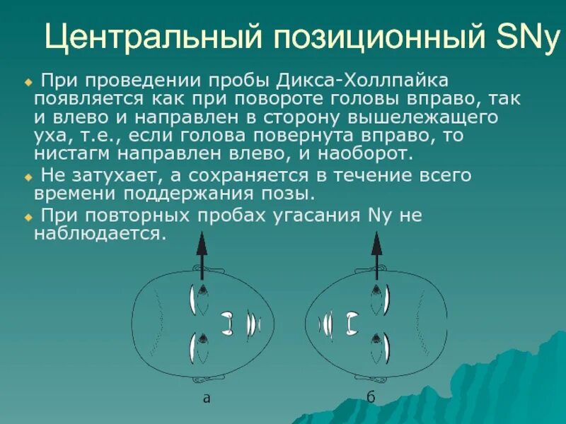 Проба холпайка. Позиционные пробы при головокружении. Позиционная проба Дикса-Холлпайка. ДППГ проба Дикса Холлпайка. Позиционные пробы при ДППГ.