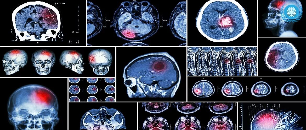 Поражение мозга последствия. ОНМК мрт. Ишемический ОНМК мрт. Инсульт поражения головного мозга. Снимок мозга после инсульта.