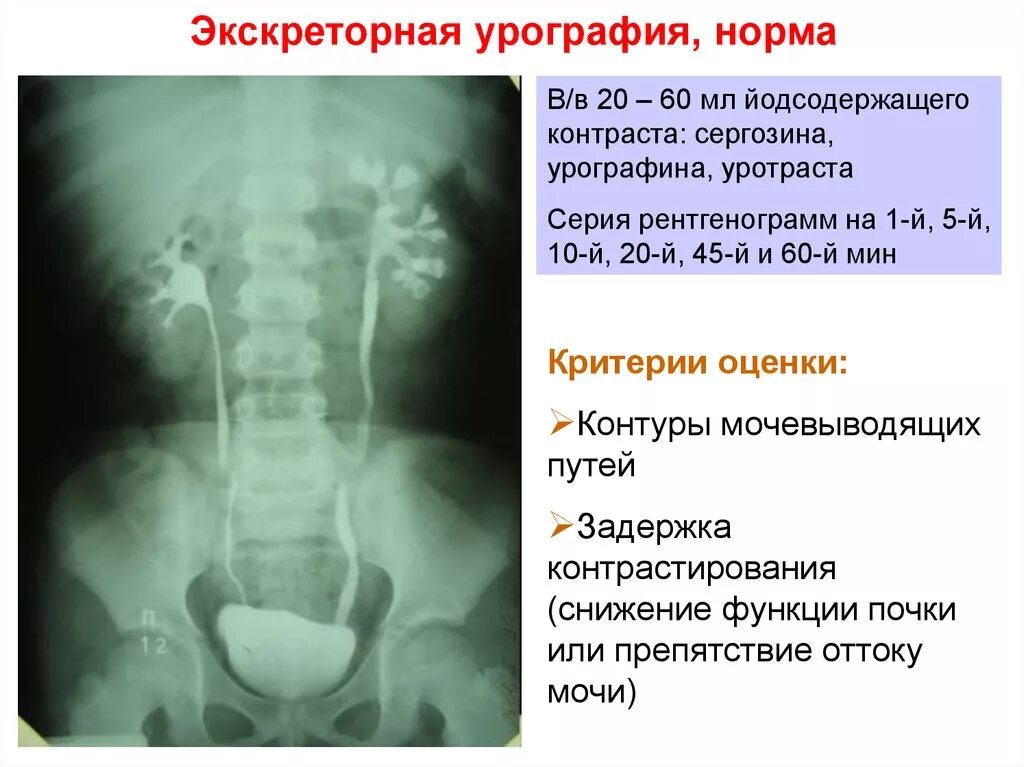 Иррадиация по ходу мочеточника. Урография почек норма рентген. Обзорная экскреторная урография норма. Внутривенная урография почек рентген. Выделительная урография.