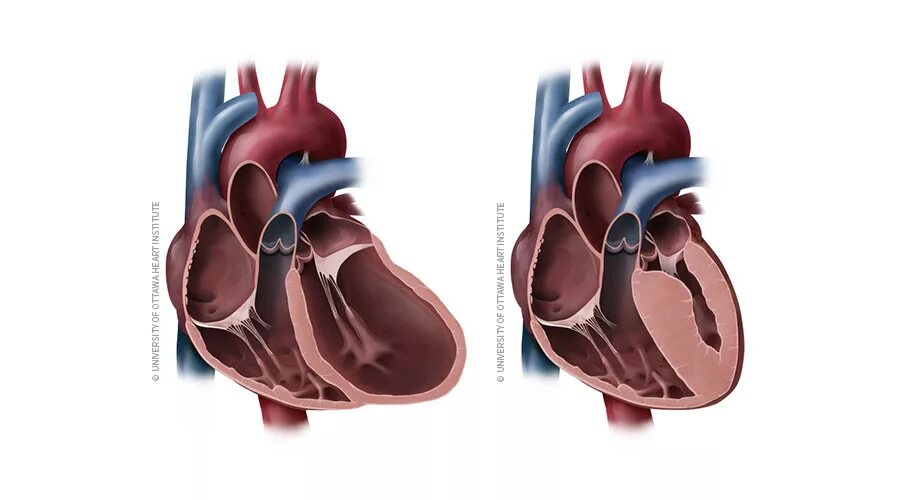 Обструктивная гипертрофическая кардиомиопатия. Гипертрофия левого желудочка при артериальной гипертензии. Гипертрофия миокарда желудочков. Гипертрофия миокарда левого желудочка сердца макропрепарат. Спортивное сердце.