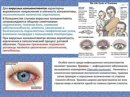 Конъюнктивит передается воздушно капельным путем